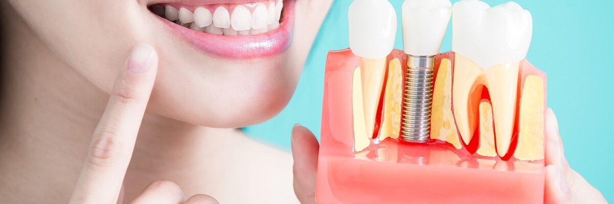 implantes dentários grátis
