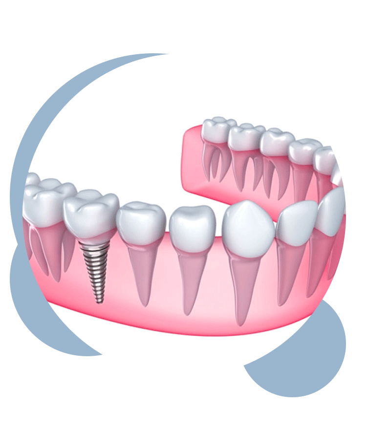 implantes dentários grátis