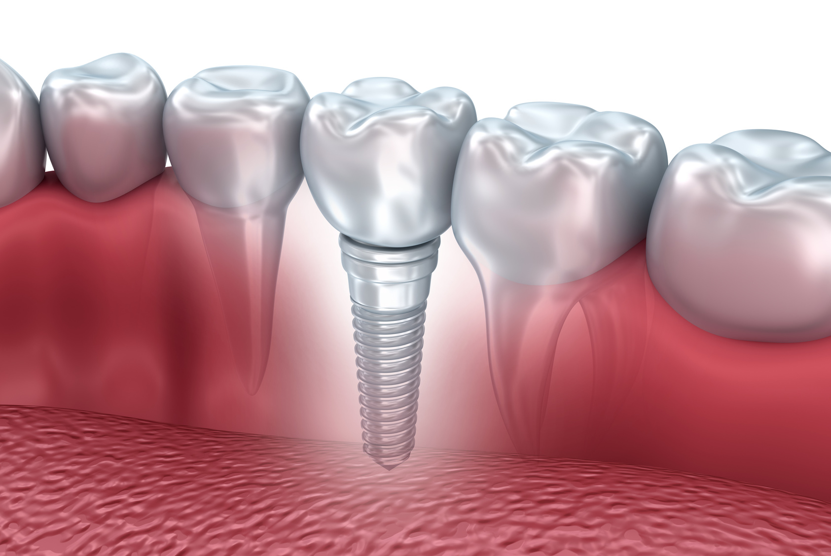 Implantes Dentários que Não Pesam no Bolso